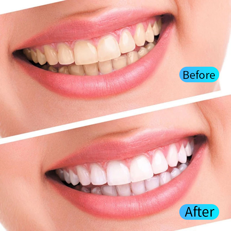 Teeth Whitening Gel Kit Oral H - Teeth Whitening Opalescence ulasan dan harga
