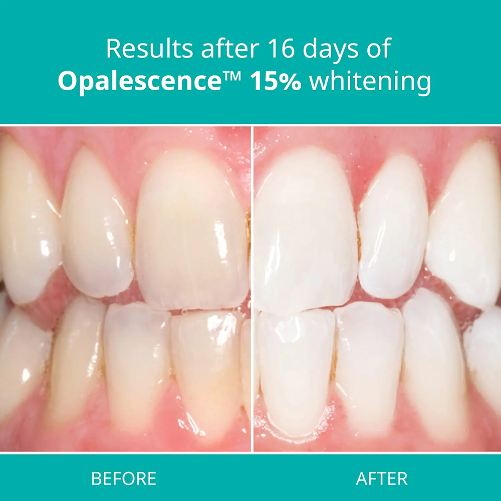 Opalescence Professional White - Teeth Whitening Opalescence ulasan dan harga