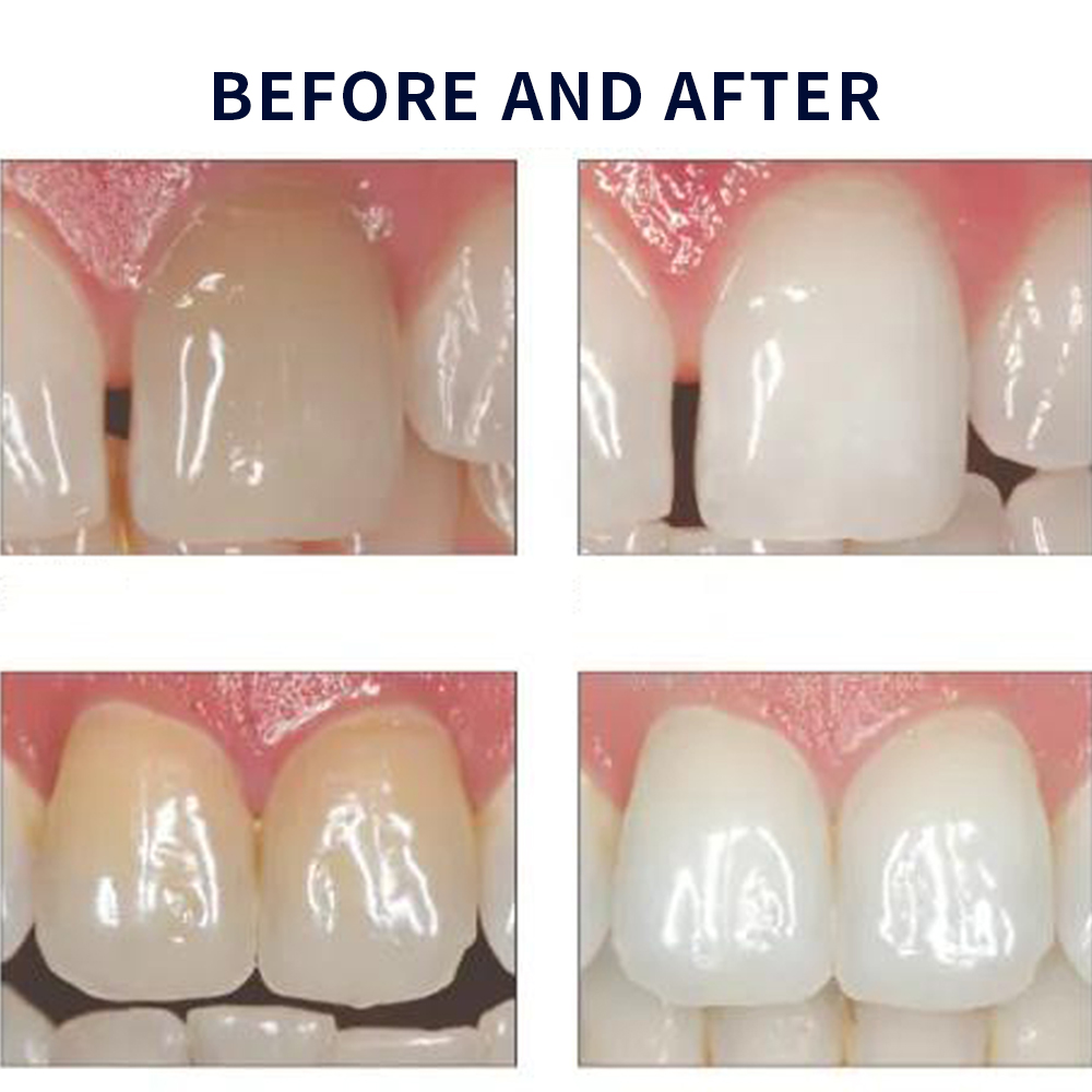 Opalescence Whitening 20% PF 2 - Teeth Whitening Opalescence ulasan dan harga