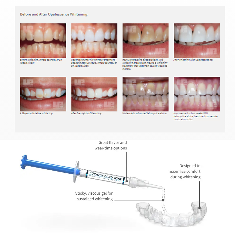 Opalescence Whitening 20% PF 2 - Teeth Whitening Opalescence ulasan dan harga