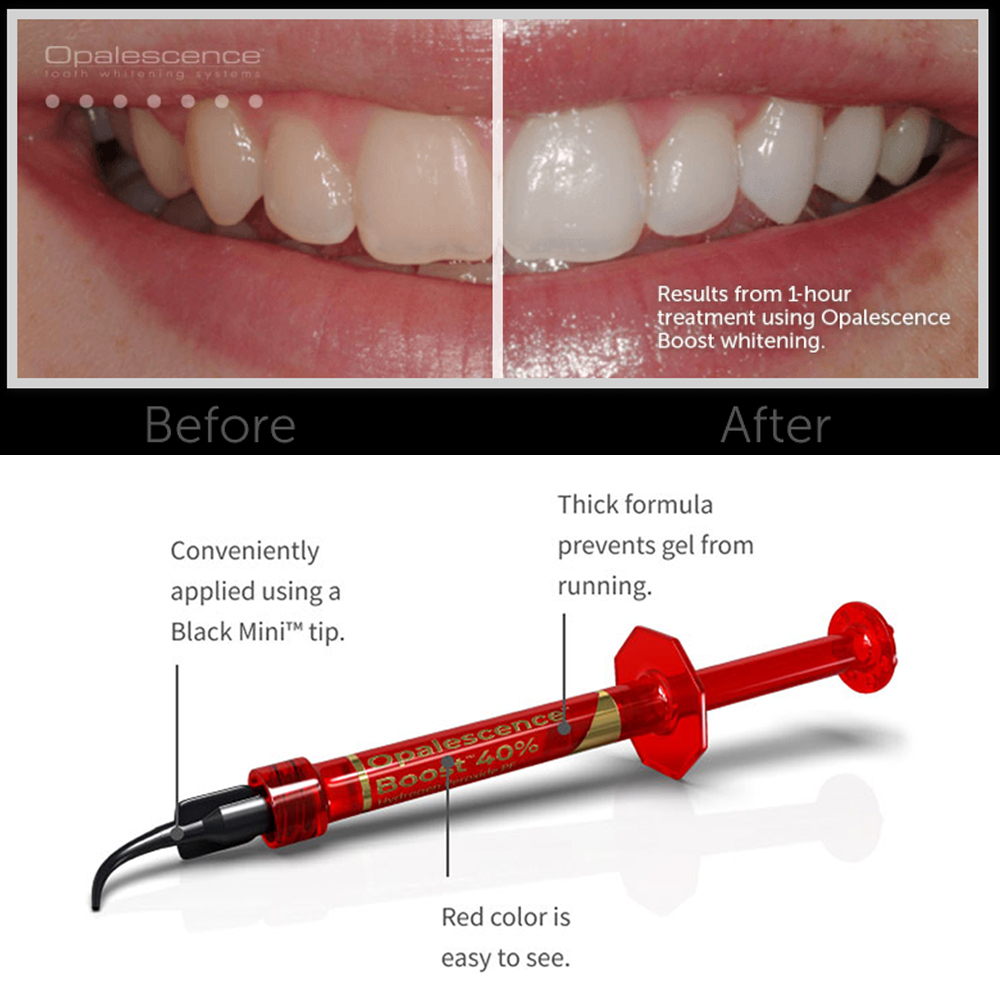 Ultradent Opalescence Boost PF - Teeth Whitening Opalescence ulasan dan harga